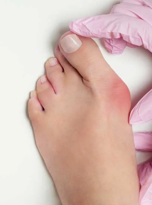 Quand intervenir sur l’hallux valgus ?