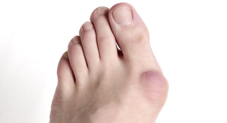 Hallux Valgus: Que dois je savoir?