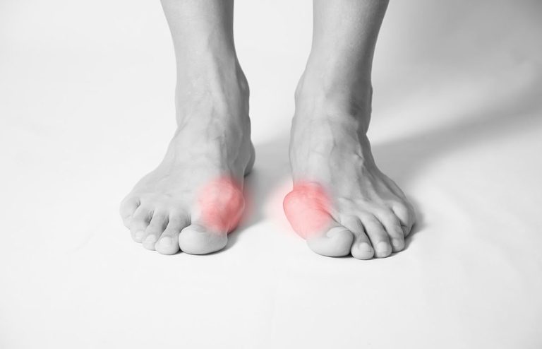 HALLUX VALGUS ET RIGIDUS