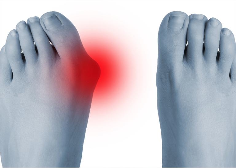 ARTHROSE DU GROS ORTEIL - hALLUS RIGIDUS