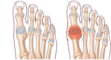 ARTHROSE DU GROS ORTEIL - hALLUS RIGIDUS