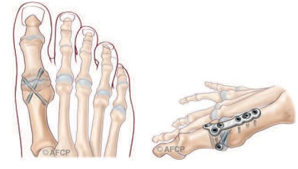 ARTHROSE DU GROS ORTEIL - hALLUS RIGIDUS