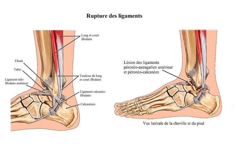 Lésions à cheville lors d’une entorse
