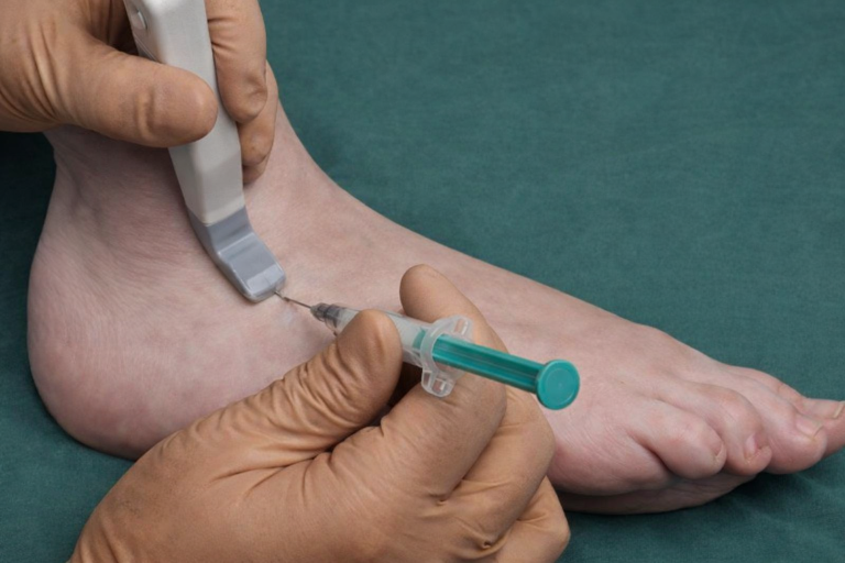 Infiltration du pied et de la cheville